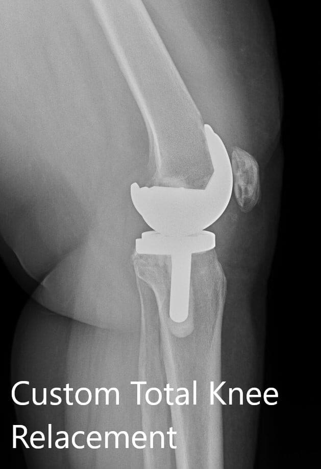 Radiografía postoperatoria que muestra la visión AP y lateral de la rodilla izquierda -img 2