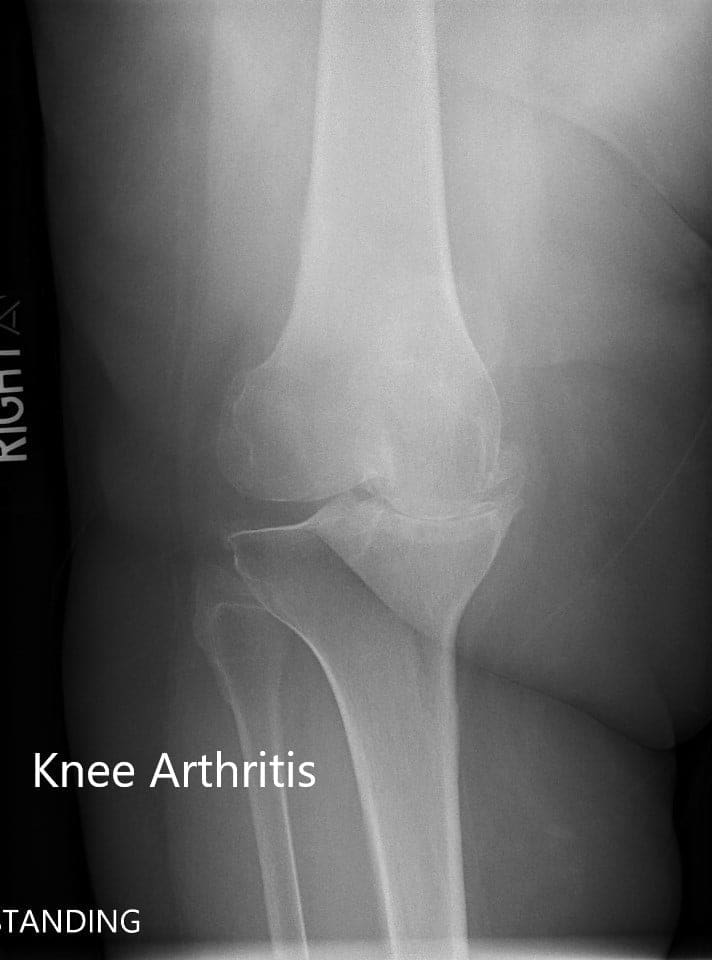 Preoperative X-ray of the right knee showing AP and lateral views Preoperative X-ray of the right knee showing AP and lateral views