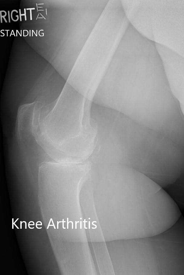 Preoperative X-ray of the right knee showing AP and lateral views - img 2 Preoperative X-ray of the right knee showing AP and lateral views - img 2