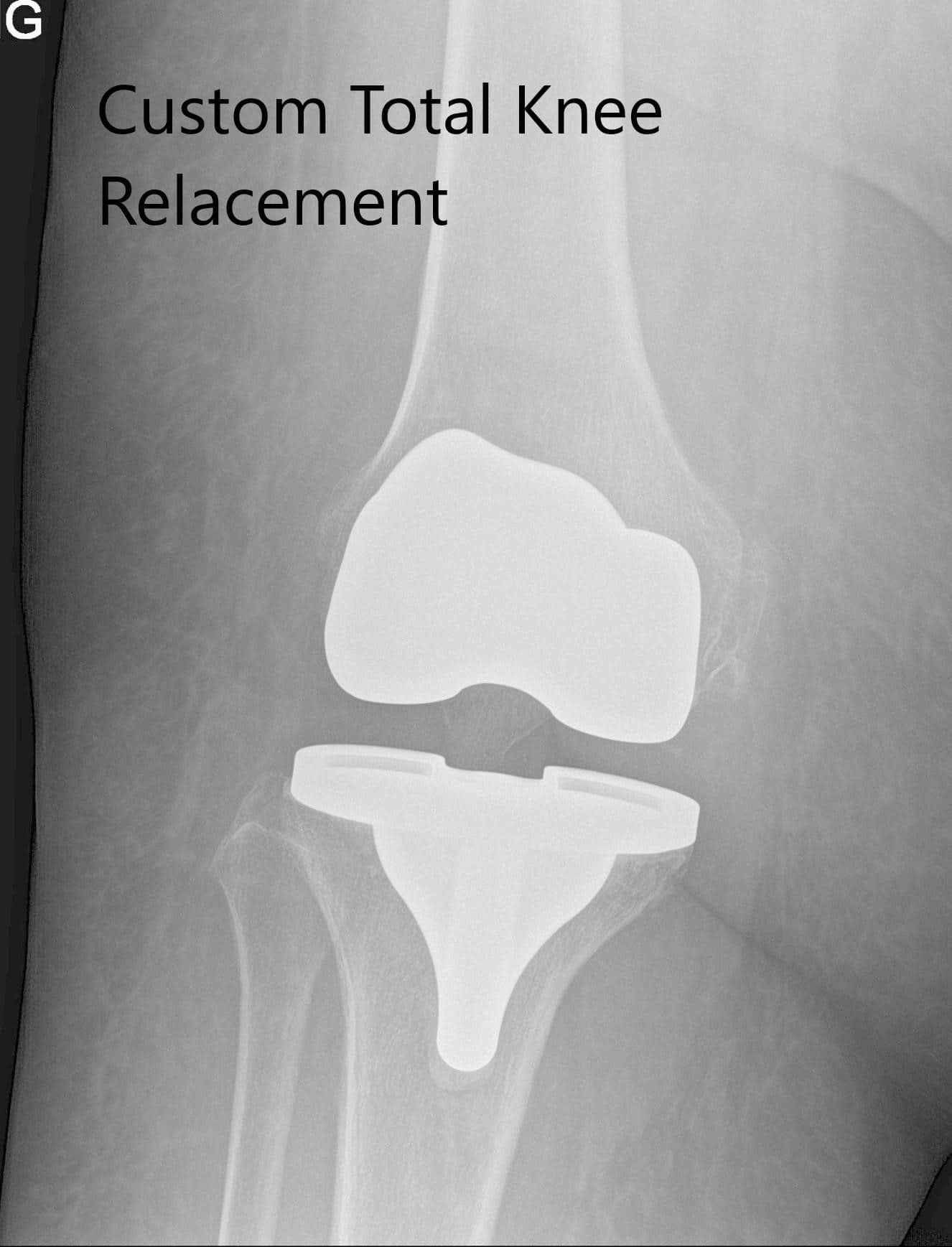 Postoperative x-ray images showing AP and lateral views of the right knee Postoperative x-ray images showing AP and lateral views of the right knee