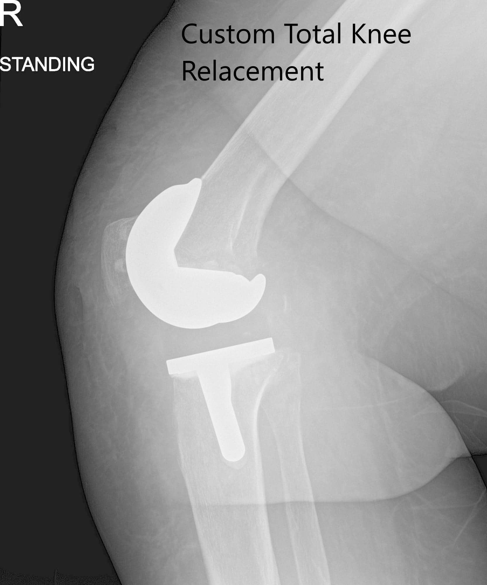 Postoperative x-ray images showing AP and lateral views of the right knee - img 2 Postoperative x-ray images showing AP and lateral views of the right knee - img 2