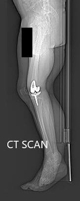 Preoperative topography CT scan images of the lower extremities - img 2 Preoperative topography CT scan images of the lower extremities - img 2