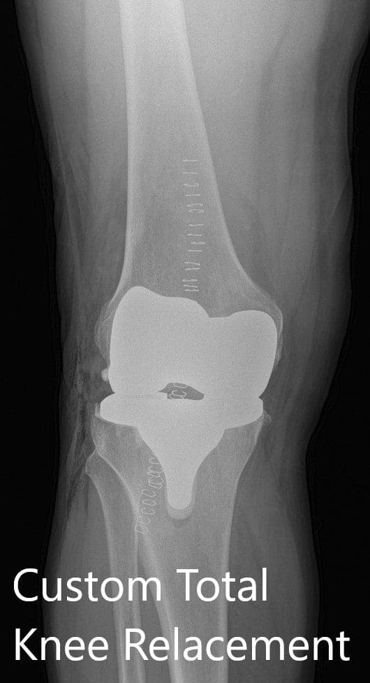 Postoperative X-ray showing AP and lateral views of the right knee Postoperative X-ray showing AP and lateral views of the right knee