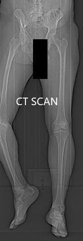 Preoperative CT scan topography images Preoperative CT scan topography images