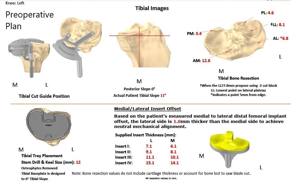 Complete Orthopedics patient specific surgical plan for a Left Custom Total Knee Replacement in a 74-year-old female