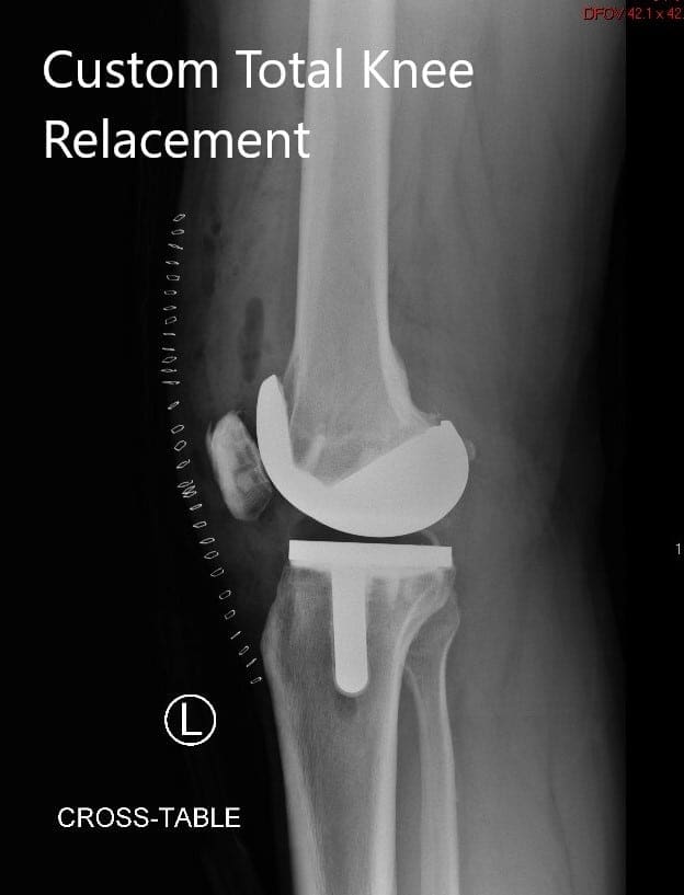 Postoperative X-ray of the left knee showing lateral and AP views Postoperative X-ray of the left knee showing lateral and AP views