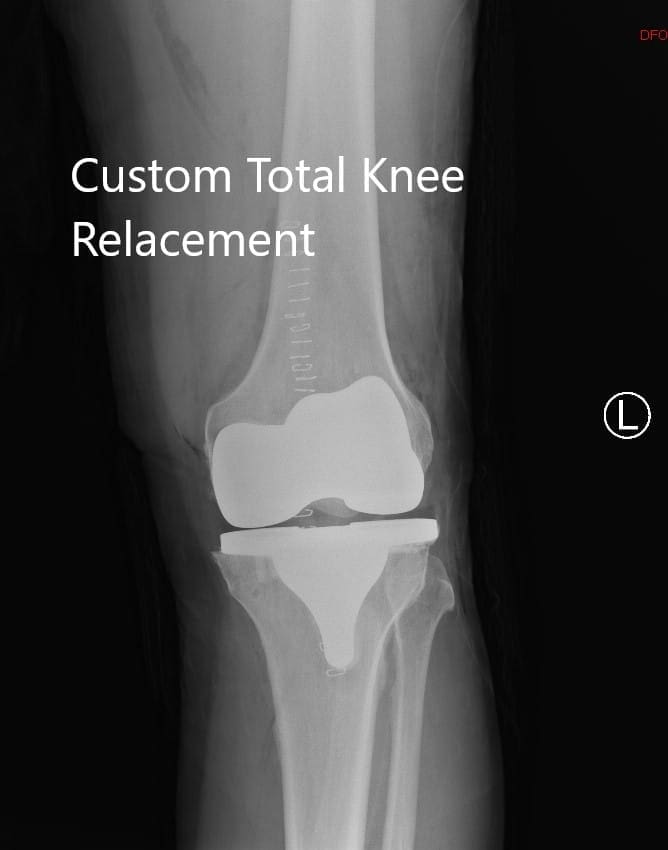 Postoperative X-ray of the left knee showing lateral and AP views - img 2 Postoperative X-ray of the left knee showing lateral and AP views - img 2