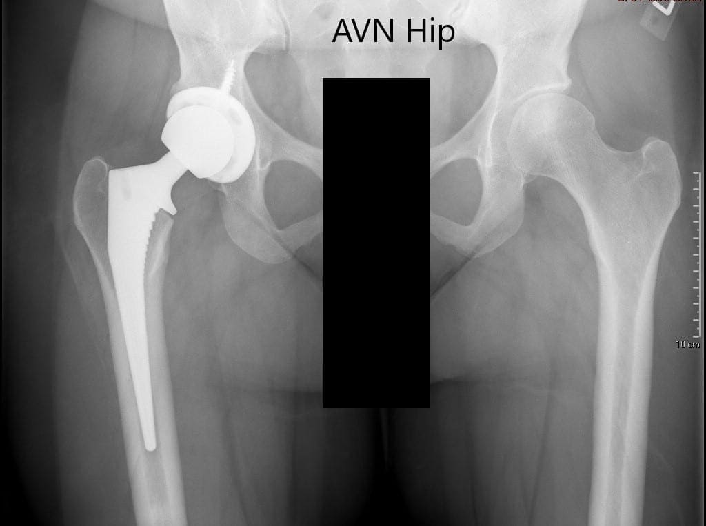 Preoperative X-ray of the pelvis with both hips showing intact artificial joint on the right side and AVN of the left hip Preoperative X-ray of the pelvis with both hips showing intact artificial joint on the right side and AVN of the left hip