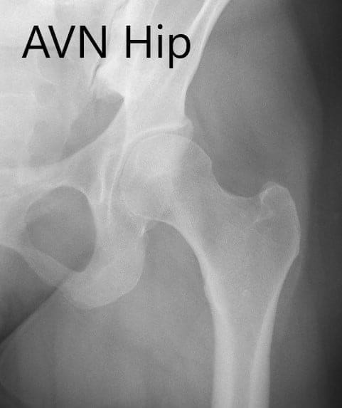 Anteroposterior view of the left hip showing pre-collapse avascular necrosis of the left hip. Anteroposterior view of the left hip showing pre-collapse avascular necrosis of the left hip.