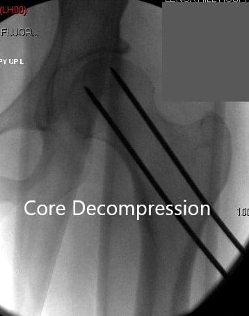 Anteroposterior view of the left hip showing pre-collapse avascular necrosis of the left hip Anteroposterior view of the left hip showing pre-collapse avascular necrosis of the left hip