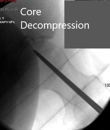 Anteroposterior view of the left hip showing pre-collapse avascular necrosis of the left hip - img 2 Anteroposterior view of the left hip showing pre-collapse avascular necrosis of the left hip - img 2