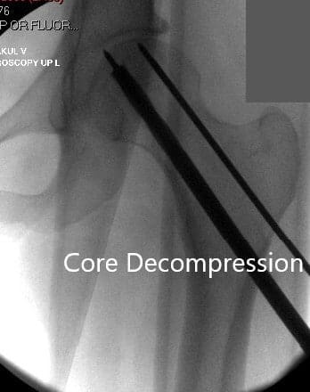 Core Decompression at the site of avascular necrosis Core Decompression at the site of avascular necrosis
