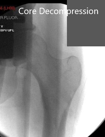 Postoperative image after core decompression and injection of stem cell harvest Postoperative image after core decompression and injection of stem cell harvest