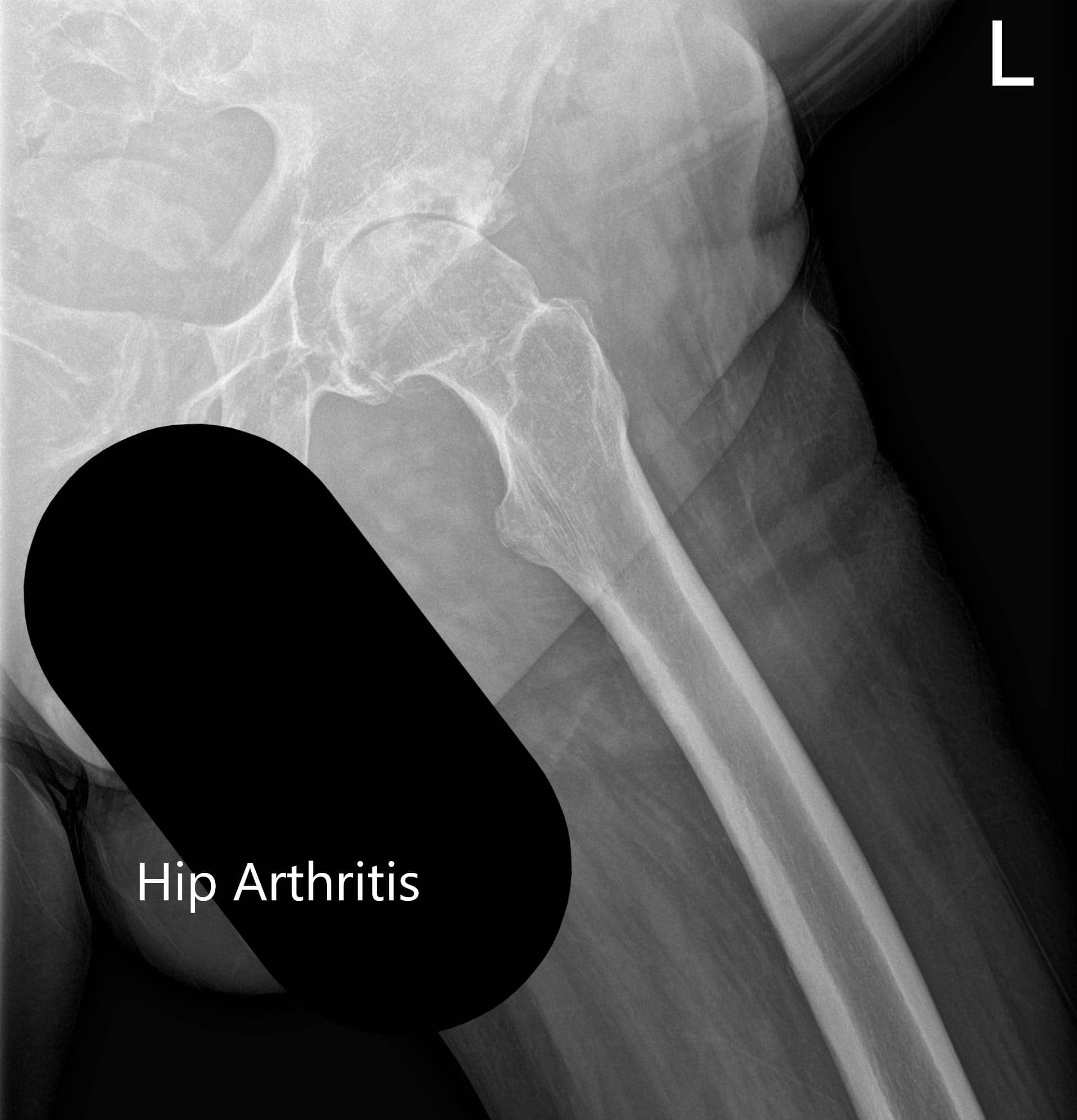 Preoperative X-ray showing the frog-legged lateral and AP view of the left hip Preoperative X-ray showing the frog-legged lateral and AP view of the left hip