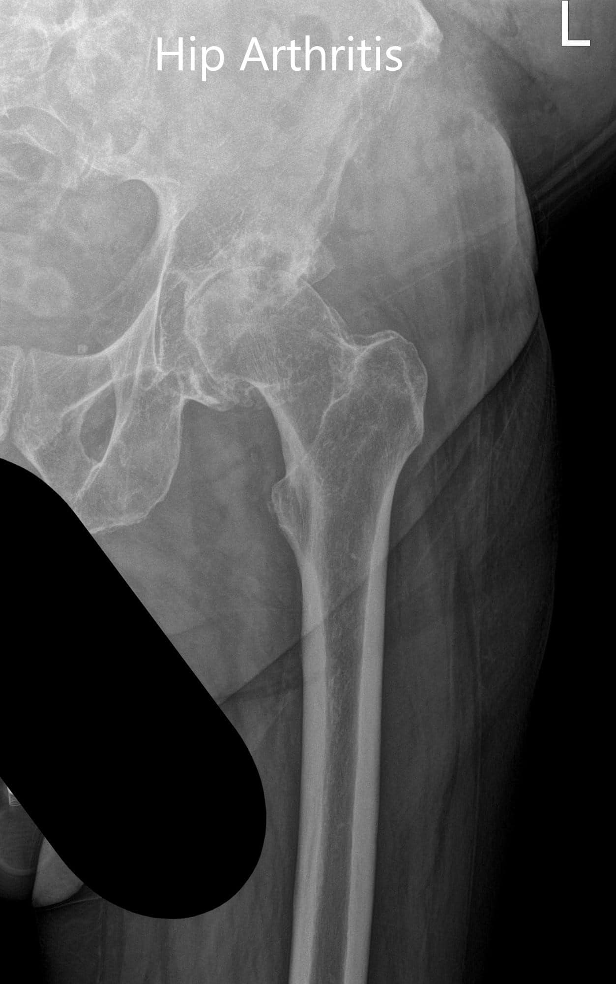 Preoperative X-ray showing the frog-legged lateral and AP view of the left hip - img 2 Preoperative X-ray showing the frog-legged lateral and AP view of the left hip - img 2