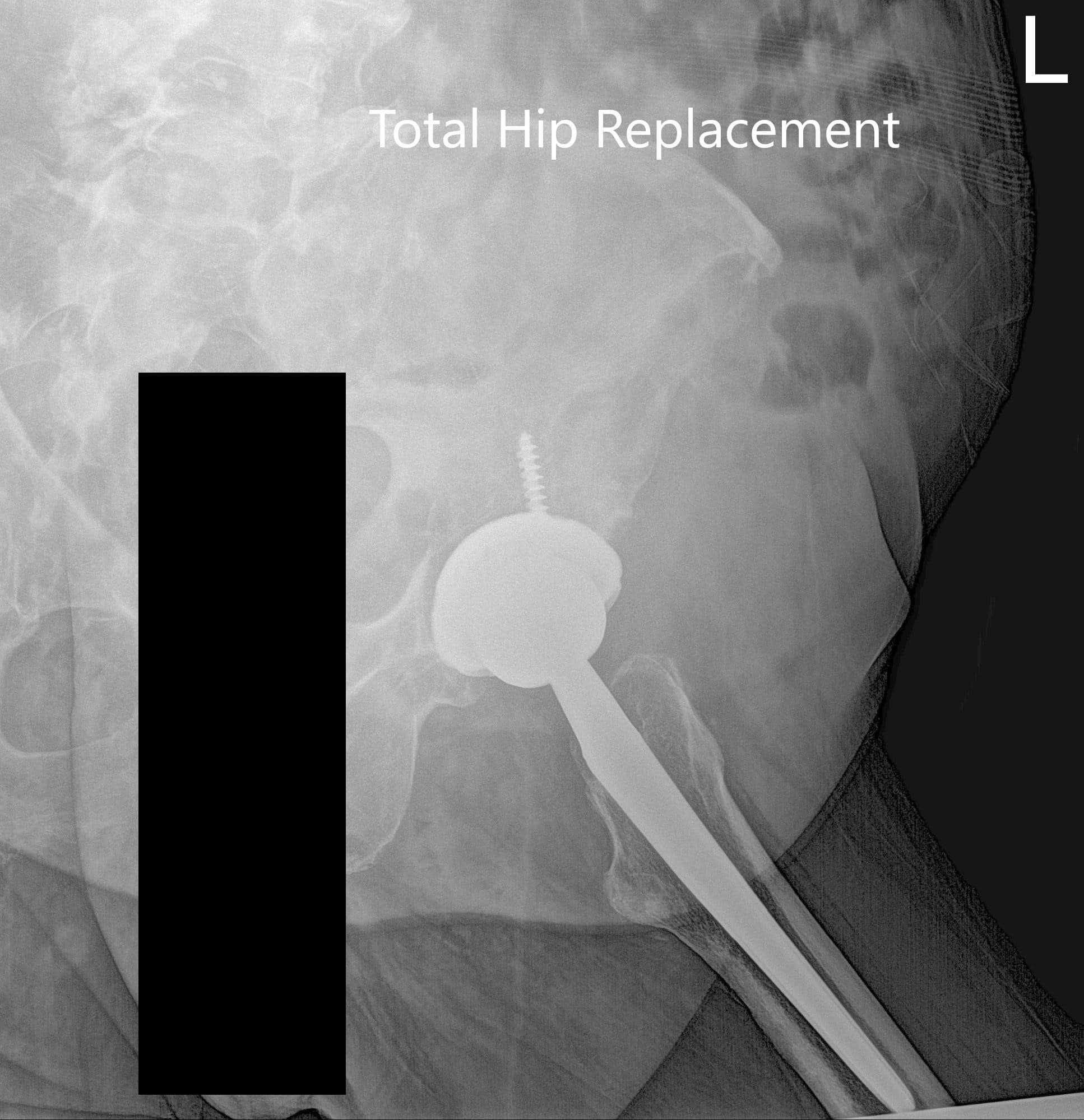 Postoperative X-ray of the Pelvis and lateral view of the left hip - img 2 Postoperative X-ray of the Pelvis and lateral view of the left hip - img 2