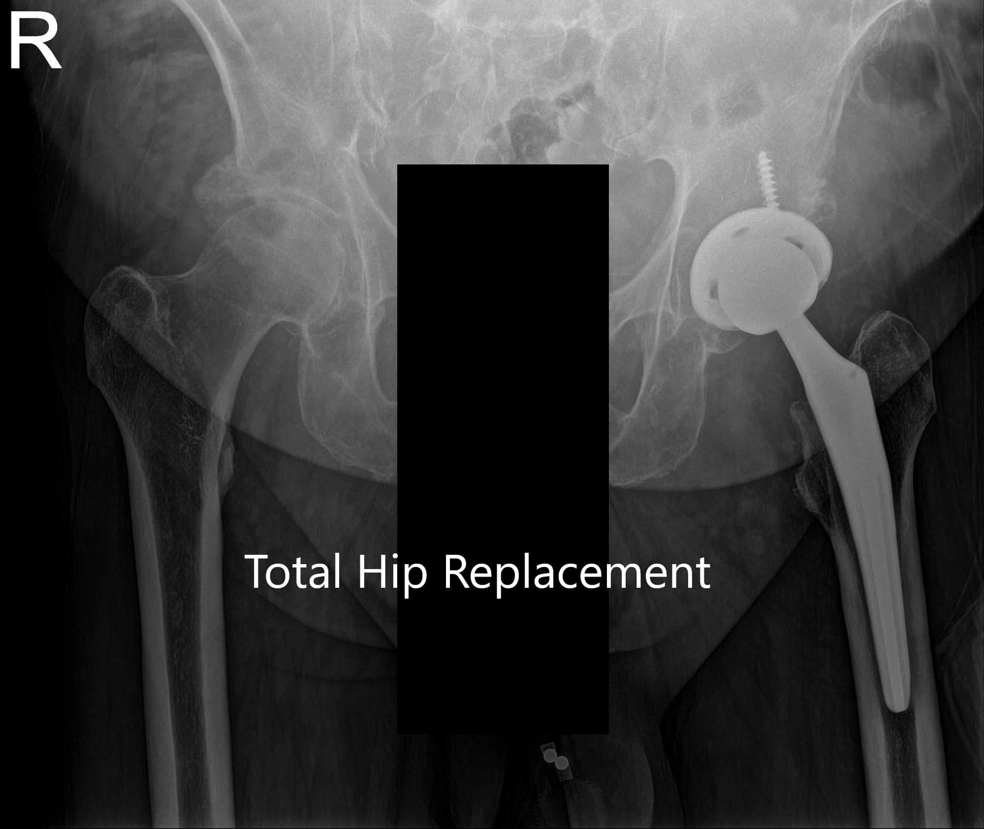 Postoperative X-ray of the Pelvis and lateral view of the left hip Postoperative X-ray of the Pelvis and lateral view of the left hip
