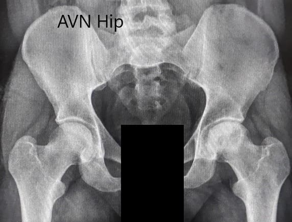 Preoperative X-ray of the pelvis with both hips in anteroposterior view showing AVN of the Left Hip Preoperative X-ray of the pelvis with both hips in anteroposterior view showing AVN of the Left Hip