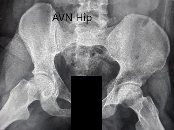 Preoperative X-ray of the pelvis with both hips in the frog-legged lateral view showing AVN of the Left Hip Preoperative X-ray of the pelvis with both hips in the frog-legged lateral view showing AVN of the Left Hip
