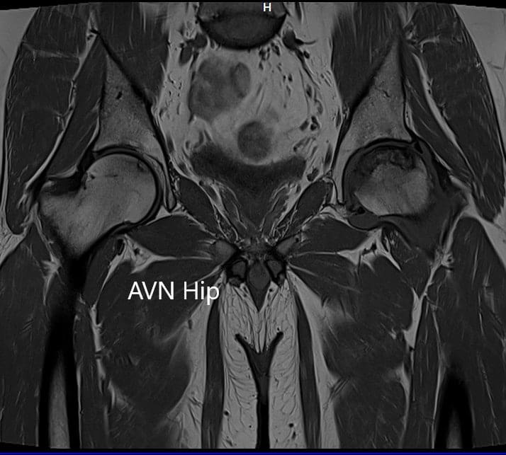 T1WI coronal section of MRI showing AVN hip T1WI coronal section of MRI showing AVN hip