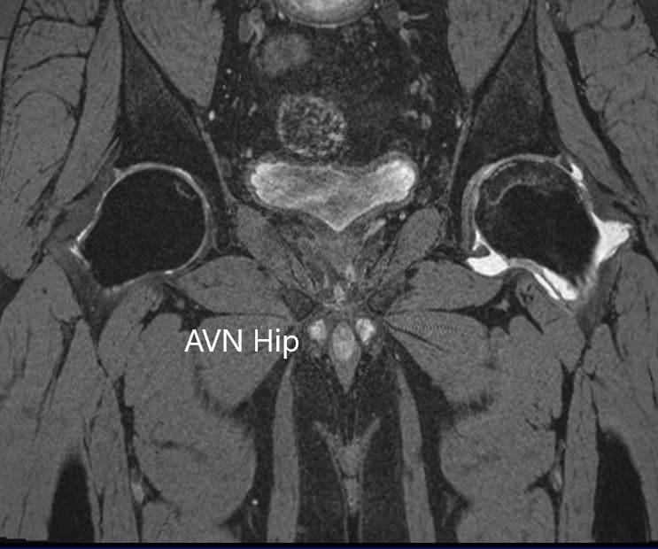 T2WI coronal section of MRI showing AVN hip T2WI coronal section of MRI showing AVN hip