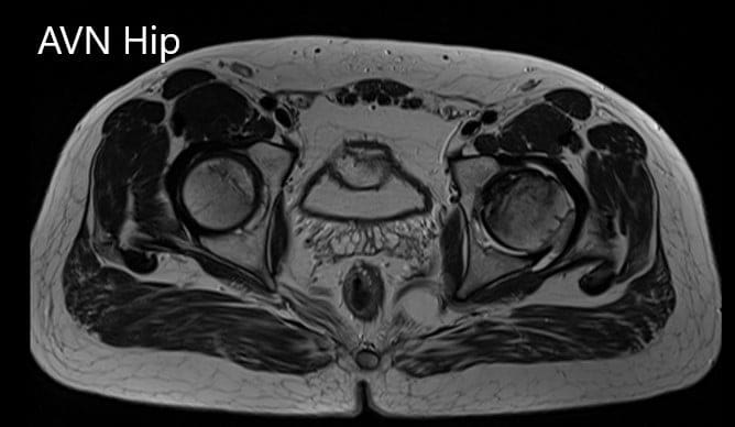Axial sections of the T1WI Axial sections of the T1WI