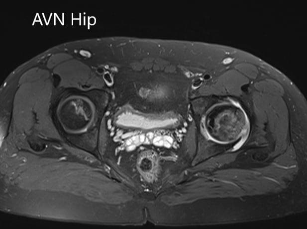 Axial sections of the T2WI Axial sections of the T2WI