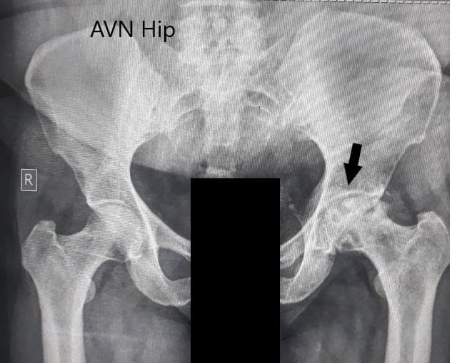 Radiografía preoperatoria de la pelvis con ambas caderas en vista anteroposterior que muestra cambios en el AVN en la cadera izquierda Radiografía preoperatoria de la pelvis con ambas caderas en vista anteroposterior que muestra cambios en el AVN en la cadera izquierda