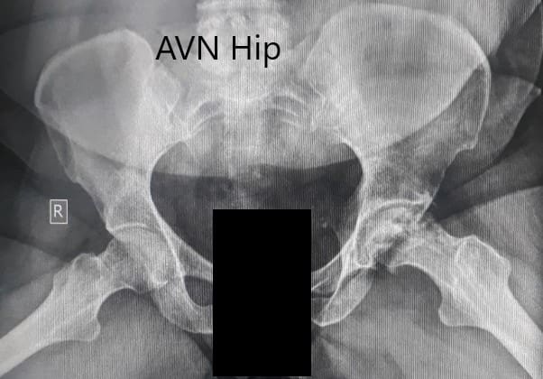 Radiografía preoperatoria de la pelvis con ambas caderas en la vista lateral con patas de rana mostrando cambios en el AVN en la cadera izquierda Radiografía preoperatoria de la pelvis con ambas caderas en la vista lateral con patas de rana mostrando cambios en el AVN en la cadera izquierda