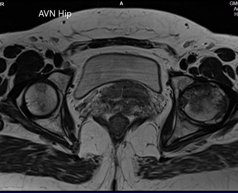T1WI de la resonancia magnética que muestra una sección axial de la cabeza femoral bilateral T1WI de la resonancia magnética que muestra una sección axial de la cabeza femoral bilateral