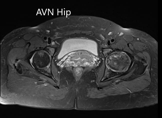 T2WI de la resonancia magnética que muestra una sección axial de la cabeza femoral bilateral T2WI de la resonancia magnética que muestra una sección axial de la cabeza femoral bilateral