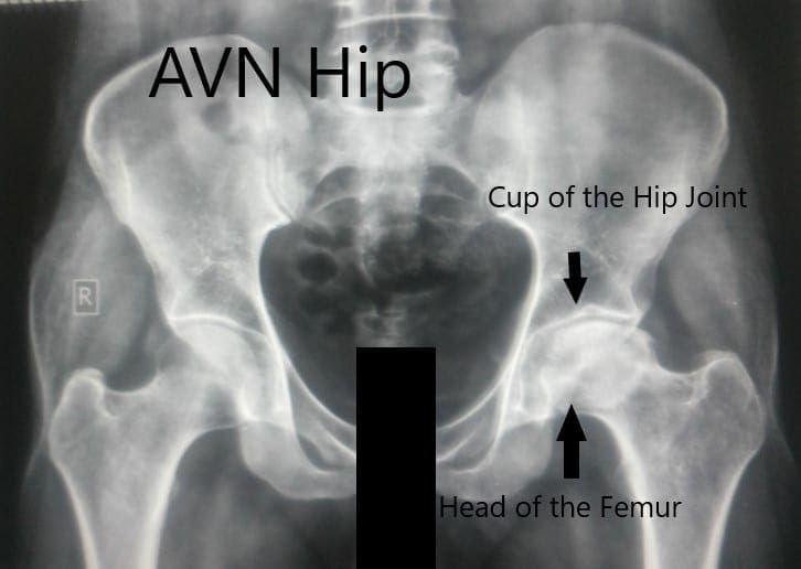 Vista anteroposterior de la pelvis con ambas caderas Vista anteroposterior de la pelvis con ambas caderas