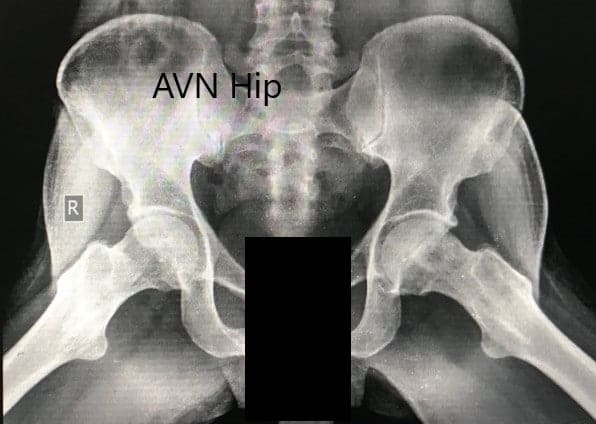 Preoperative X-ray of the pelvis with both hips in the frog-legged lateral view showing AVN of the bilateral hips Preoperative X-ray of the pelvis with both hips in the frog-legged lateral view showing AVN of the bilateral hips
