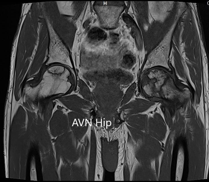 T1WI coronal section of MRI showing AVN hip T1WI coronal section of MRI showing AVN hip