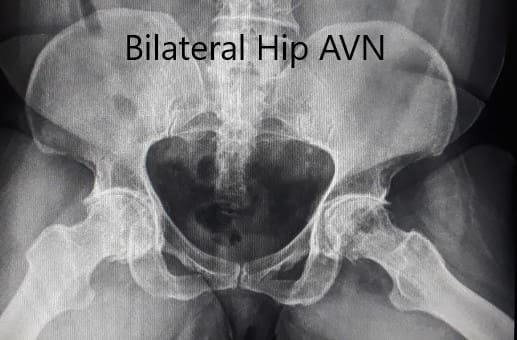 Pre-operative X-ray of the pelvis in frog-legged lateral views