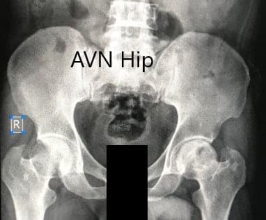 Preoperative X-ray of the pelvis with both hips in anteroposterior view showing AVN of the Left Hip Preoperative X-ray of the pelvis with both hips in anteroposterior view showing AVN of the Left Hip