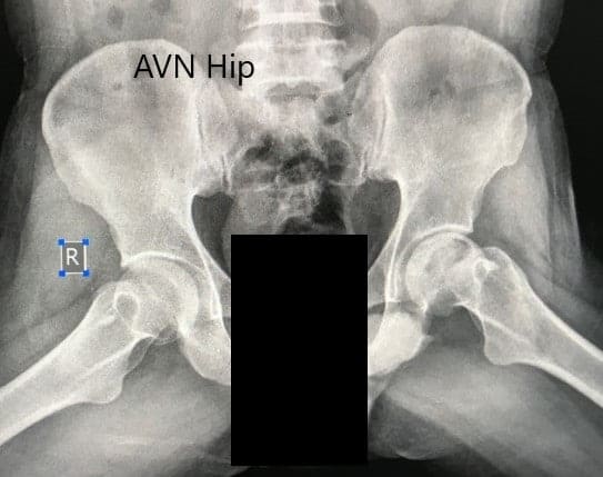 Preoperative X-ray of the pelvis with both hips in the frog-legged lateral view showing AVN of the Left Hip Preoperative X-ray of the pelvis with both hips in the frog-legged lateral view showing AVN of the Left Hip