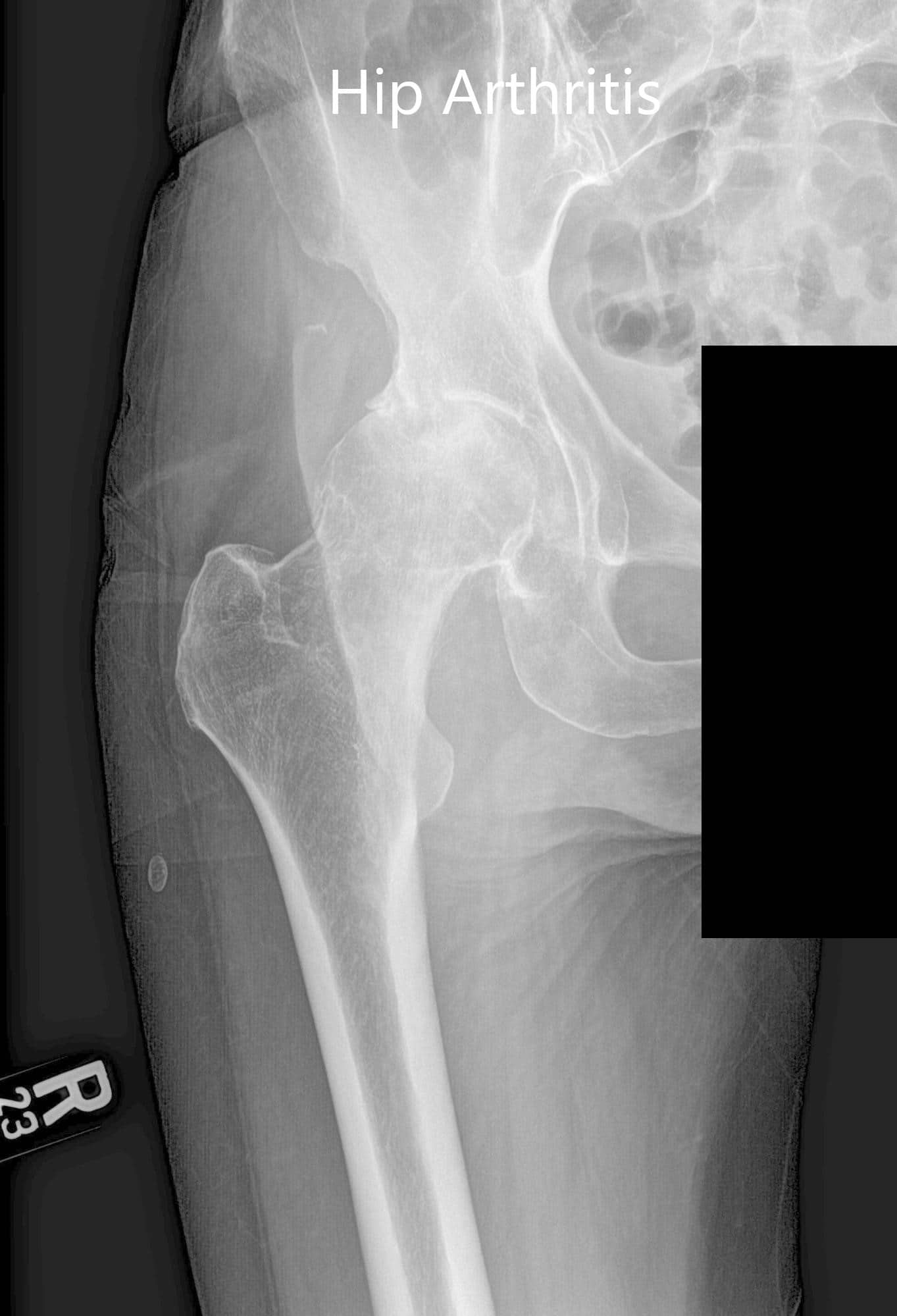 Vistas preoperatorias y laterales de la articulación de la cadera derecha