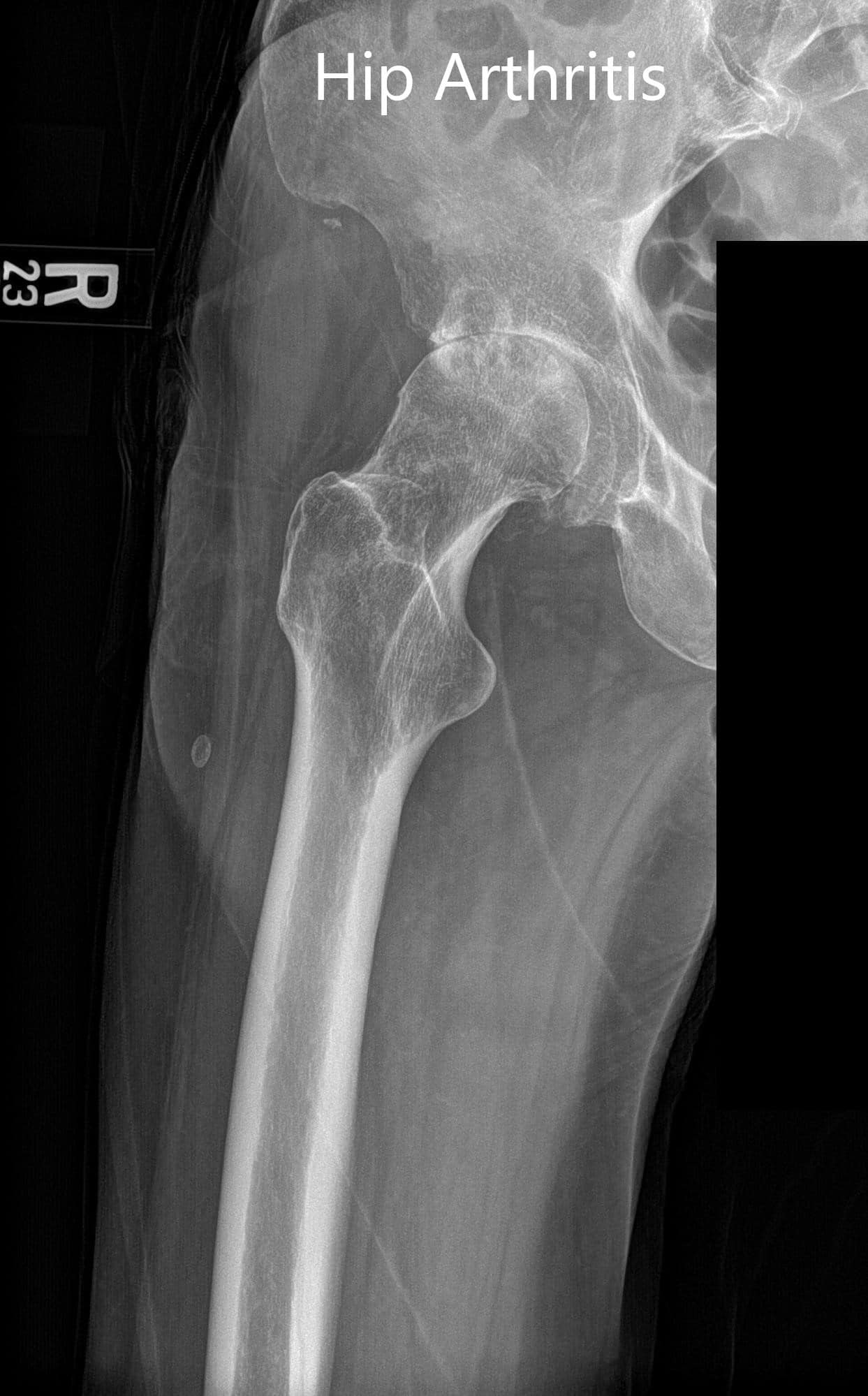 Vistas preoperatorias y laterales de la articulación derecha de la cadera - img 2
