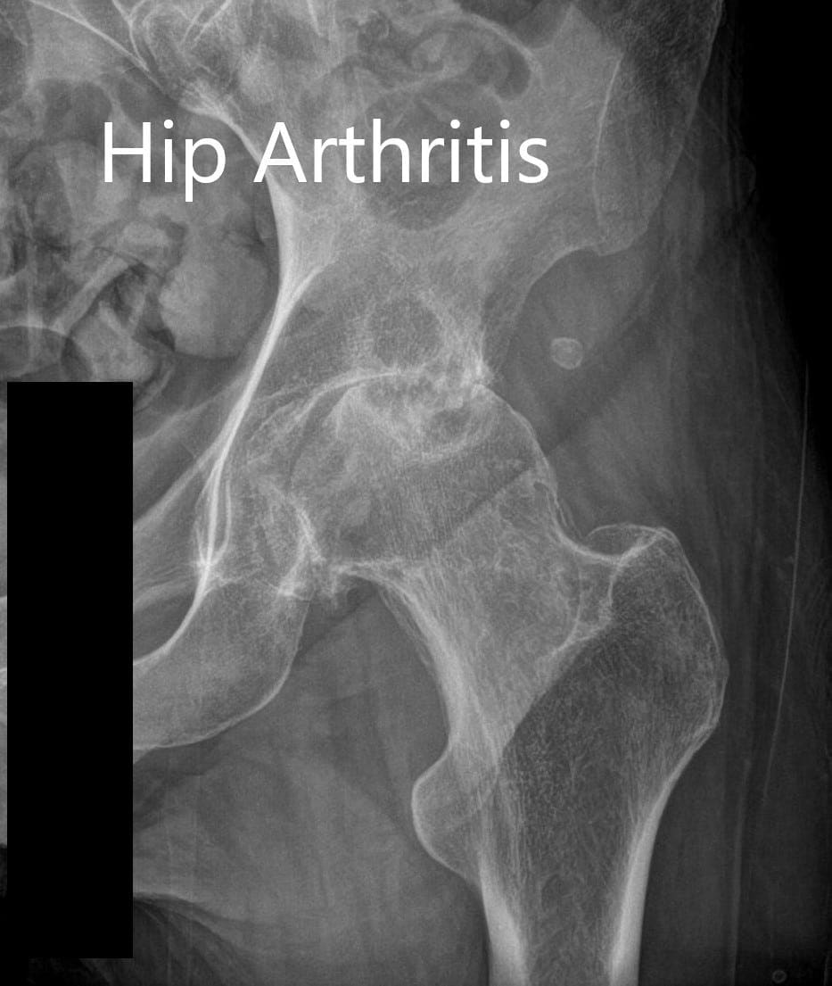 Radiografía preoperatoria de la cadera izquierda que mostró vistas AP y laterales