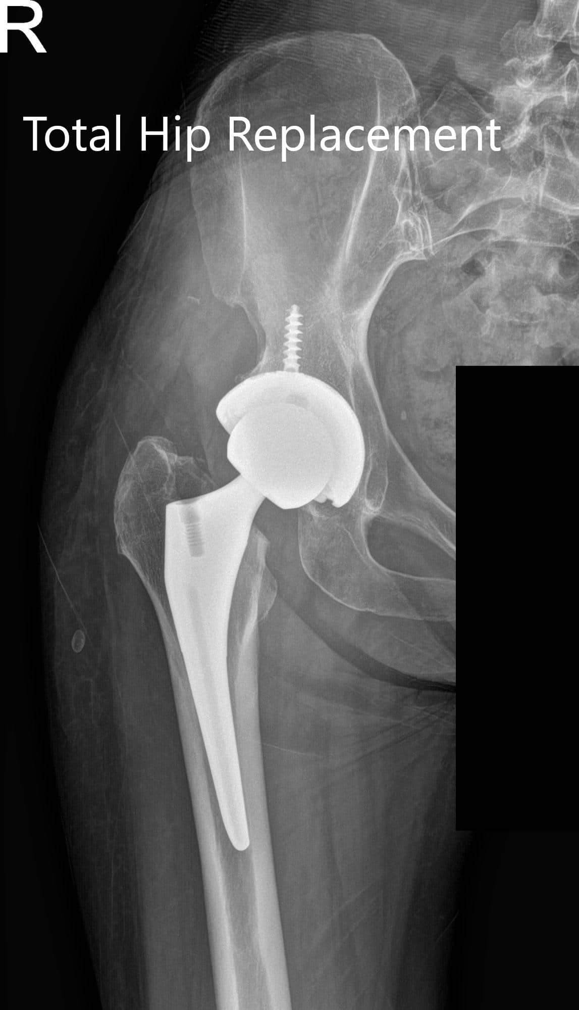 Radiografía postoperatoria que muestra la visión AP y lateral de la cadera derecha