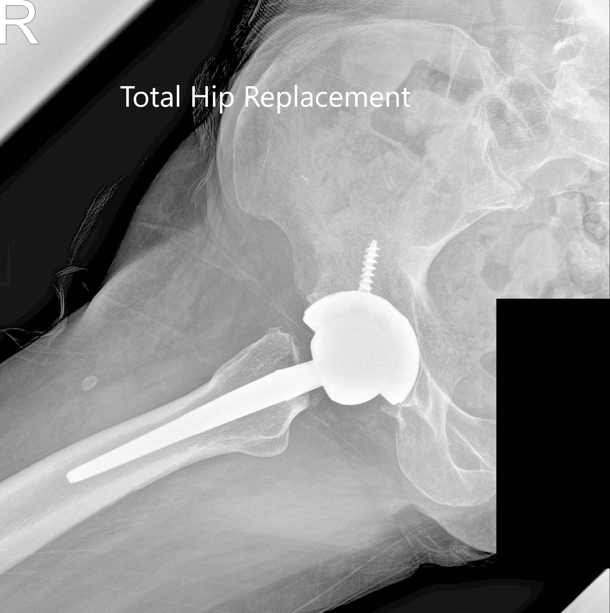 Radiografía postoperatoria que muestra la visión AP y lateral de la cadera derecha - IMG 2