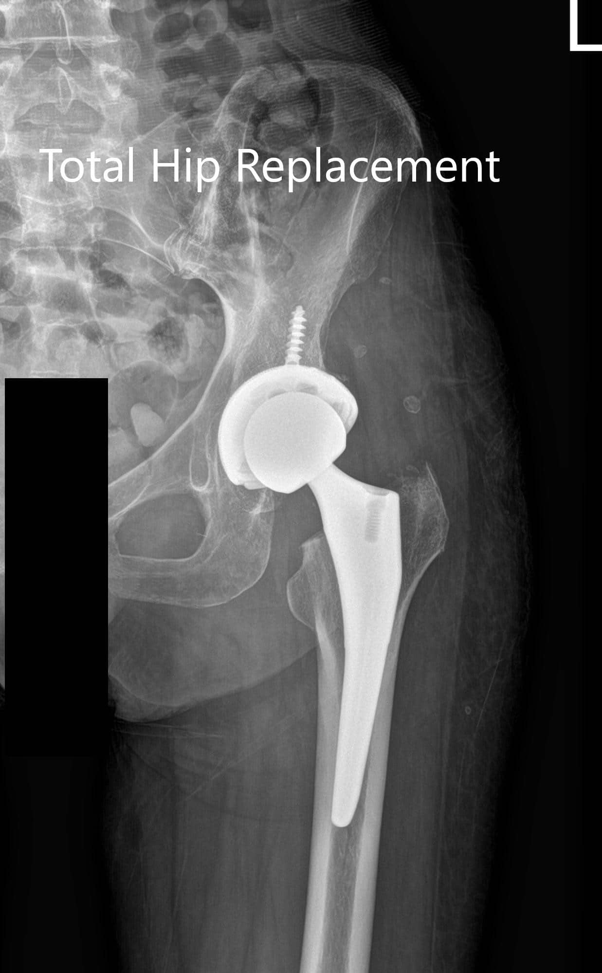 Radiografía postoperatoria de la cadera izquierda que muestra vistas AP y laterales