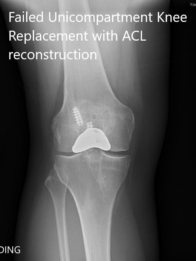 Preoperative x-ray showing the anteroposterior and lateral views of the right knee Preoperative x-ray showing the anteroposterior and lateral views of the right knee