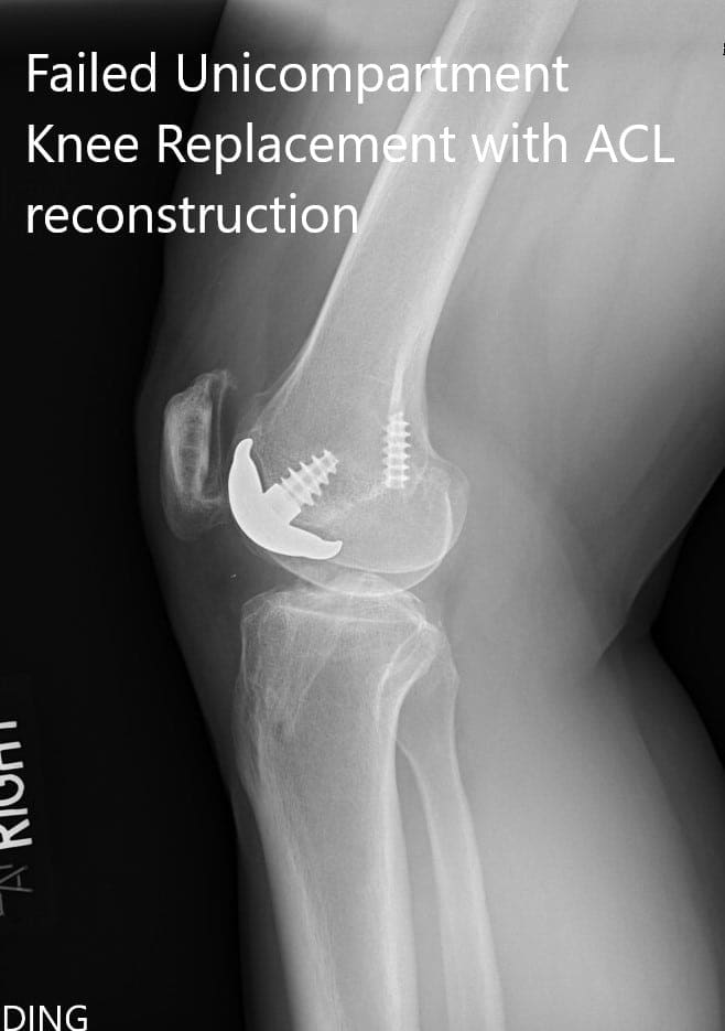 Preoperative x-ray showing the anteroposterior and lateral views of the right knee - img 2 Preoperative x-ray showing the anteroposterior and lateral views of the right knee - img 2