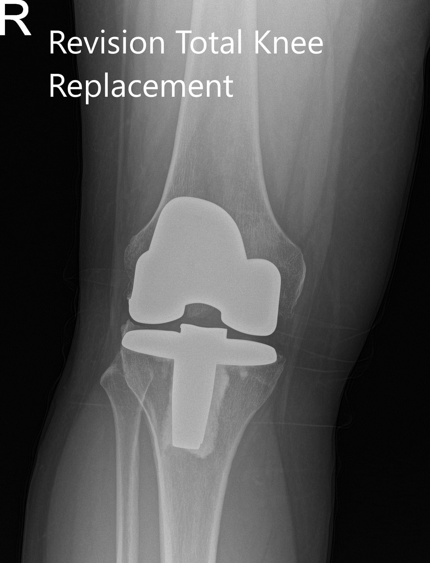 Postoperative x-ray showing the anteroposterior and lateral views of the right knee Postoperative x-ray showing the anteroposterior and lateral views of the right knee