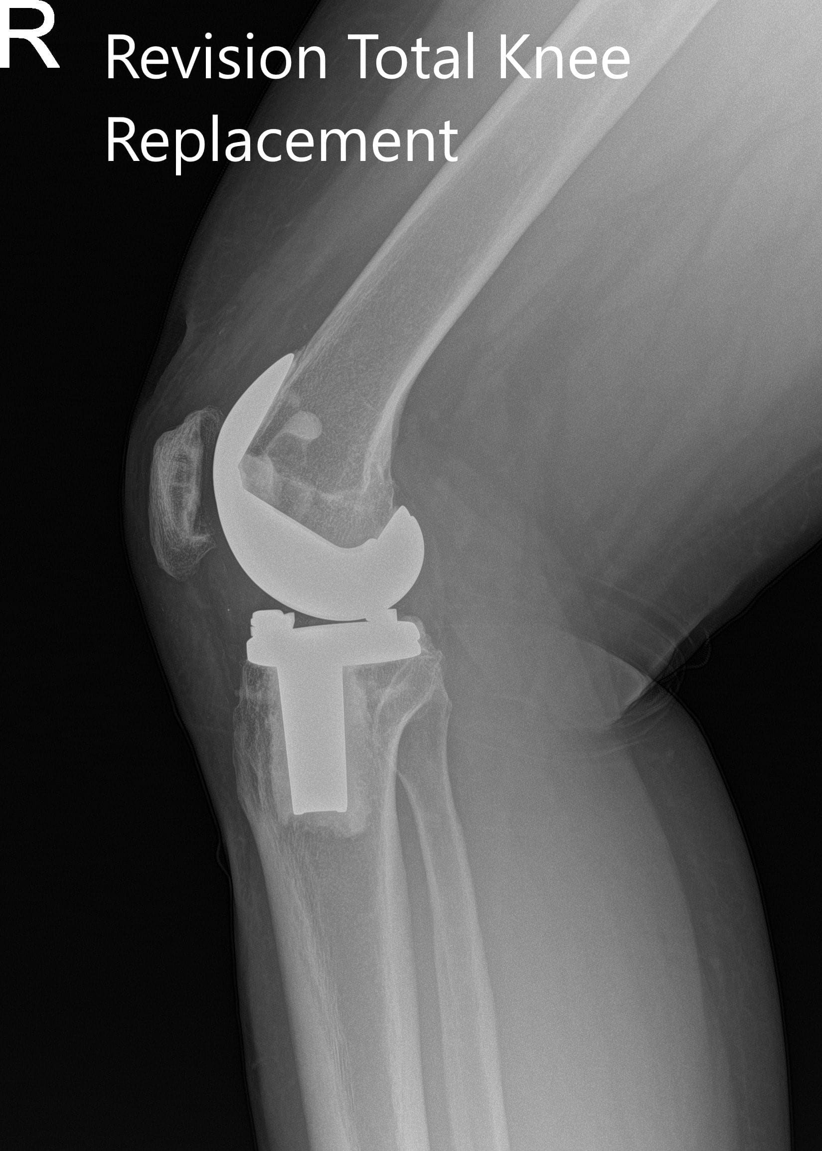 Postoperative x-ray showing the anteroposterior and lateral views of the right knee - img 2 Postoperative x-ray showing the anteroposterior and lateral views of the right knee - img 2