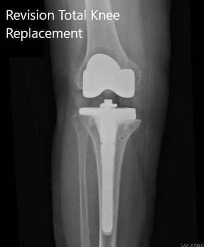 Radiografía postoperatoria que muestra las vistas lateral y anteroposterior de la rodilla derecha - img 2 Radiografía postoperatoria que muestra las vistas lateral y anteroposterior de la rodilla derecha - img 2