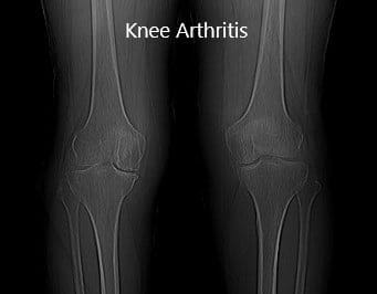 Radiografía preoperatoria que muestra la vista AP de las articulaciones bilaterales de la rodilla Radiografía preoperatoria que muestra la vista AP de las articulaciones bilaterales de la rodilla