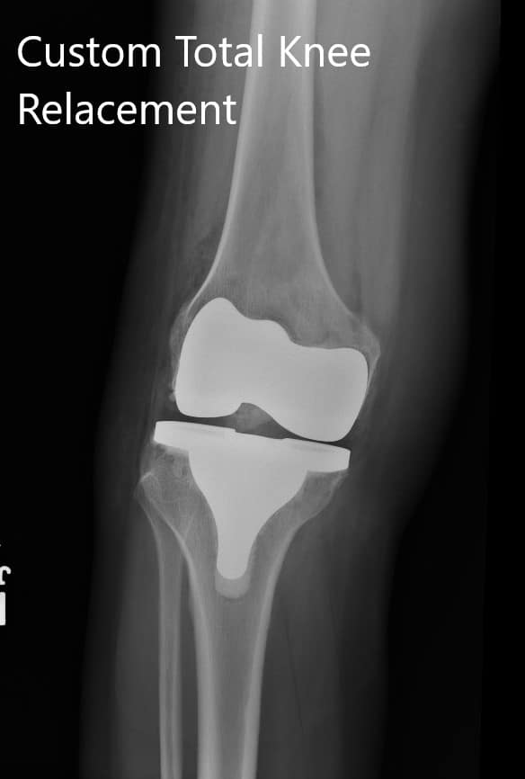 Imágenes postoperatorias que muestran vistas AP y oblicuas de la rodilla derecha Imágenes postoperatorias que muestran vistas AP y oblicuas de la rodilla derecha